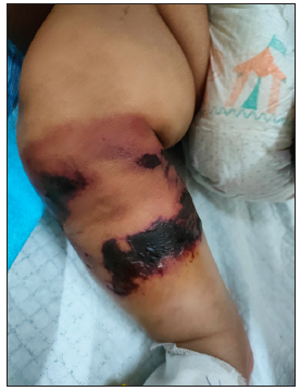 Multiple irregular purpuric macules with areas of necrosis, blistering and blackish detachable skin over right leg (Day 2 of presentation).